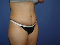 Tummy Tuck After Photo by Moneer Jaibaji, MD; Coronado, CA - Case 23192