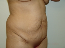 Tummy Tuck Before Photo by Moneer Jaibaji, MD; Coronado, CA - Case 23192