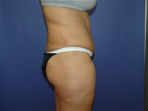 Tummy Tuck After Photo by Moneer Jaibaji, MD; Coronado, CA - Case 23192
