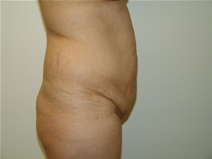 Tummy Tuck Before Photo by Moneer Jaibaji, MD; Coronado, CA - Case 23192