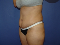 Tummy Tuck After Photo by Moneer Jaibaji, MD; Coronado, CA - Case 23192