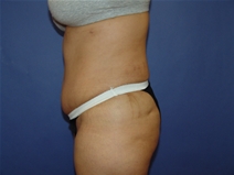 Tummy Tuck After Photo by Moneer Jaibaji, MD; Coronado, CA - Case 23192