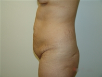 Tummy Tuck Before Photo by Moneer Jaibaji, MD; Coronado, CA - Case 23192