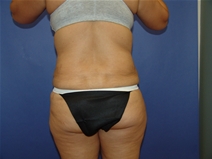 Tummy Tuck After Photo by Moneer Jaibaji, MD; Coronado, CA - Case 23192