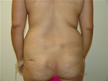 Tummy Tuck Before Photo by Moneer Jaibaji, MD; Coronado, CA - Case 23192