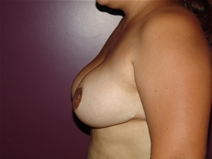 Breast Reduction After Photo by Moneer Jaibaji, MD; Coronado, CA - Case 23228