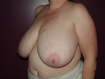 Breast Reduction Before Photo by Moneer Jaibaji, MD; Coronado, CA - Case 23246