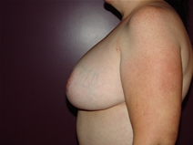Breast Reduction After Photo by Moneer Jaibaji, MD; Coronado, CA - Case 23246