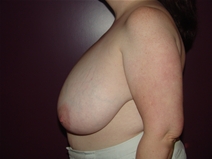 Breast Reduction Before Photo by Moneer Jaibaji, MD; Coronado, CA - Case 23246