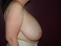 Breast Reduction Before Photo by Moneer Jaibaji, MD; Coronado, CA - Case 23246