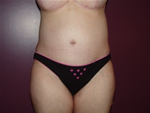 Tummy Tuck After Photo by Moneer Jaibaji, MD; Coronado, CA - Case 23247