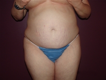 Tummy Tuck Before Photo by Moneer Jaibaji, MD; Coronado, CA - Case 23247