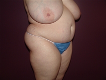 Tummy Tuck Before Photo by Moneer Jaibaji, MD; Coronado, CA - Case 23247