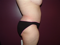 Tummy Tuck After Photo by Moneer Jaibaji, MD; Coronado, CA - Case 23247