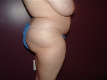 Tummy Tuck Before Photo by Moneer Jaibaji, MD; Coronado, CA - Case 23247
