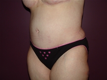 Tummy Tuck After Photo by Moneer Jaibaji, MD; Coronado, CA - Case 23247