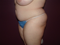 Tummy Tuck Before Photo by Moneer Jaibaji, MD; Coronado, CA - Case 23247