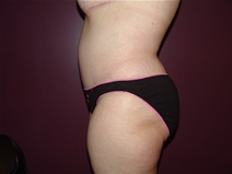 Tummy Tuck After Photo by Moneer Jaibaji, MD; Coronado, CA - Case 23247