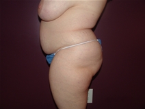 Tummy Tuck Before Photo by Moneer Jaibaji, MD; Coronado, CA - Case 23247