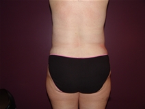 Tummy Tuck After Photo by Moneer Jaibaji, MD; Coronado, CA - Case 23247