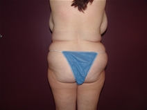 Tummy Tuck Before Photo by Moneer Jaibaji, MD; Coronado, CA - Case 23247
