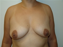 Breast Augmentation Before Photo by Moneer Jaibaji, MD; Coronado, CA - Case 23272