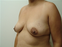 Breast Augmentation Before Photo by Moneer Jaibaji, MD; Coronado, CA - Case 23272