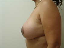 Breast Augmentation After Photo by Moneer Jaibaji, MD; Coronado, CA - Case 23272