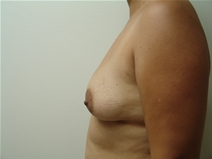 Breast Augmentation Before Photo by Moneer Jaibaji, MD; Coronado, CA - Case 23272