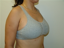 Breast Augmentation After Photo by Moneer Jaibaji, MD; Coronado, CA - Case 23272
