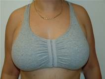 Breast Augmentation Before Photo by Moneer Jaibaji, MD; Coronado, CA - Case 23272