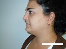 Liposuction Before Photo by Moneer Jaibaji, MD; Coronado, CA - Case 23399