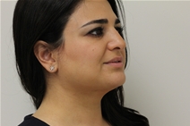 Liposuction After Photo by Moneer Jaibaji, MD; Coronado, CA - Case 23399