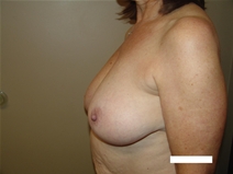 Breast Reduction Before Photo by Moneer Jaibaji, MD; Coronado, CA - Case 23400