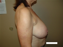 Breast Reduction Before Photo by Moneer Jaibaji, MD; Coronado, CA - Case 23400