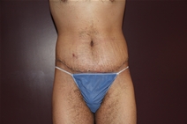Body Contouring After Photo by Moneer Jaibaji, MD; Coronado, CA - Case 23401