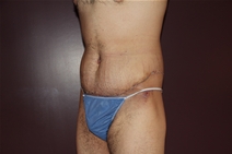 Body Contouring After Photo by Moneer Jaibaji, MD; Coronado, CA - Case 23401
