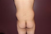 Body Contouring Before Photo by Moneer Jaibaji, MD; Coronado, CA - Case 23401