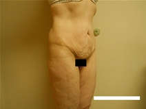 Body Contouring Before Photo by Moneer Jaibaji, MD; Coronado, CA - Case 23402