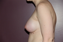 Breast Augmentation After Photo by Moneer Jaibaji, MD; Coronado, CA - Case 23405