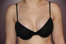 Breast Augmentation After Photo by Moneer Jaibaji, MD; Coronado, CA - Case 23405