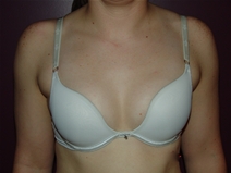 Breast Augmentation Before Photo by Moneer Jaibaji, MD; Coronado, CA - Case 23405