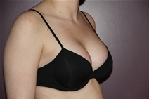 Breast Augmentation After Photo by Moneer Jaibaji, MD; Coronado, CA - Case 23405