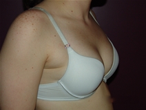Breast Augmentation Before Photo by Moneer Jaibaji, MD; Coronado, CA - Case 23405