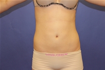 Liposuction After Photo by Moneer Jaibaji, MD; Coronado, CA - Case 23446