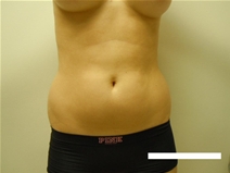 Liposuction Before Photo by Moneer Jaibaji, MD; Coronado, CA - Case 23446