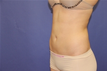 Liposuction After Photo by Moneer Jaibaji, MD; Coronado, CA - Case 23446