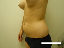 Liposuction Before Photo by Moneer Jaibaji, MD; Coronado, CA - Case 23446
