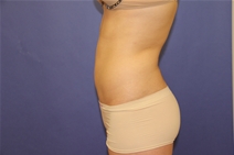 Liposuction After Photo by Moneer Jaibaji, MD; Coronado, CA - Case 23446
