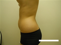 Liposuction Before Photo by Moneer Jaibaji, MD; Coronado, CA - Case 23446